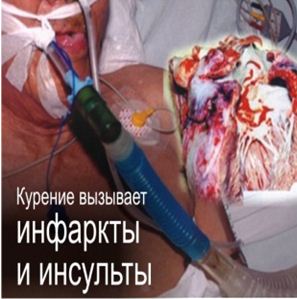 Kazakhstan 2013 Health Effects heart - heart attack and stroke, lived experience